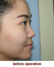 plastic_surgery_augmentation_rhinoplasty